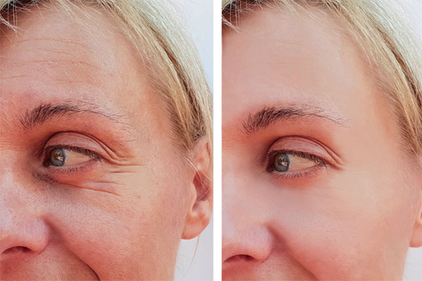 Female face showing wrinkles, such as crows feet and frown lines which are shown as smoothed out following anti-wrinkle injections