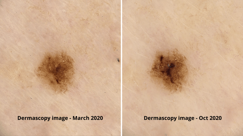 Regular skin checks identified changes in a mole to detect skin cancer early