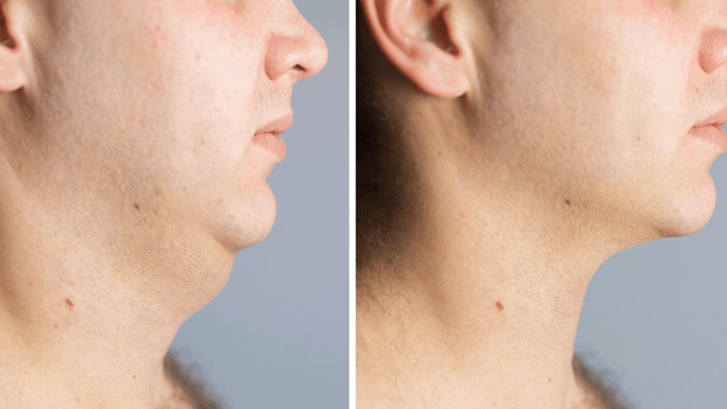 Before and After Double chin treatment to dissolve fat with Kybella (Belkyra)