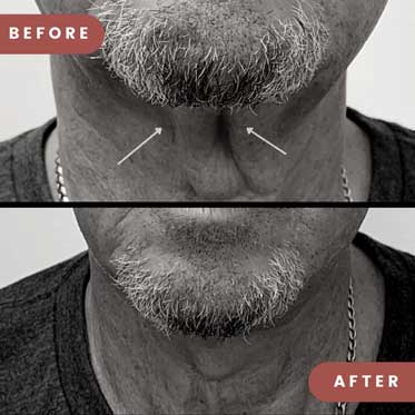 male anti wrinkle correction before and after