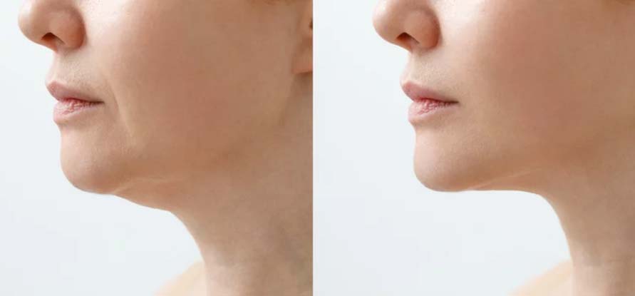 double chin removal toorak
