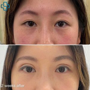 Before and After Asian Upper Eyelid Surgery - 2 weeks later