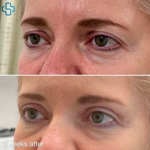 Before and After Customised Upper Blepharoplasty - 3 Weeks Later.