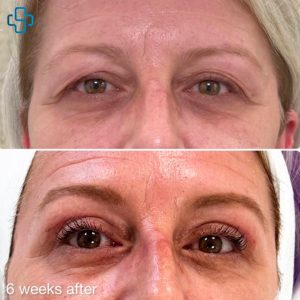 Before and After Upper Blepharoplasty Surgery to treat droopy eyes - 6 weeks later.