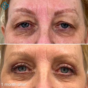 Before and After image showing the results 1 month after upper eyelid surgery was performed.
